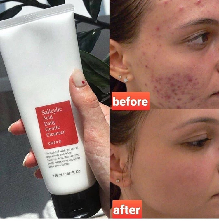 شوینده صورت کوزارکس حاوی سالیسیلیک اسید 150 میل